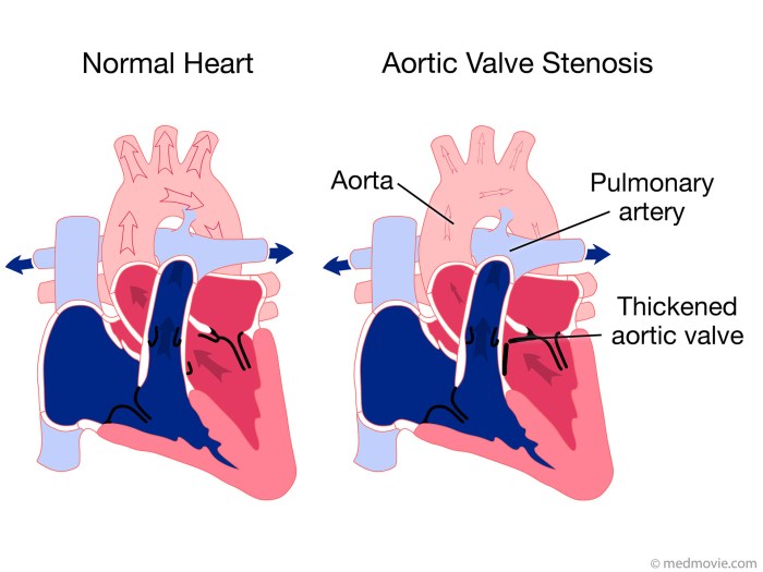 A nurse is assessing an infant who has aortic stenosis