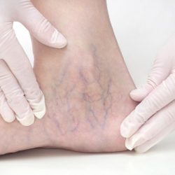 Veins varicose vein venous bmj insufficiency visible swelling