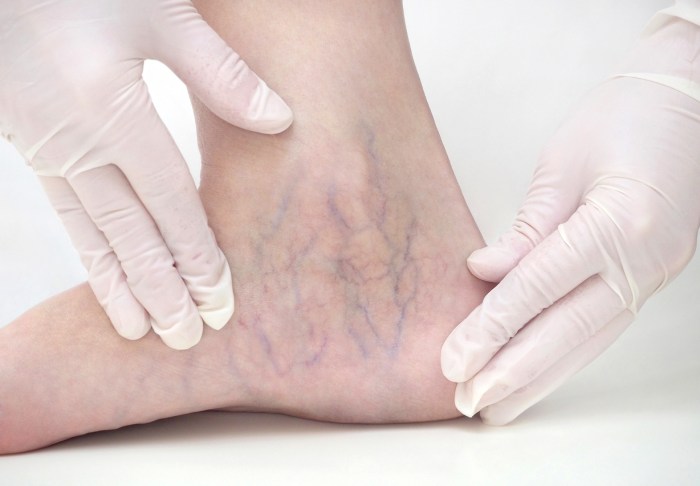 Veins varicose vein venous bmj insufficiency visible swelling